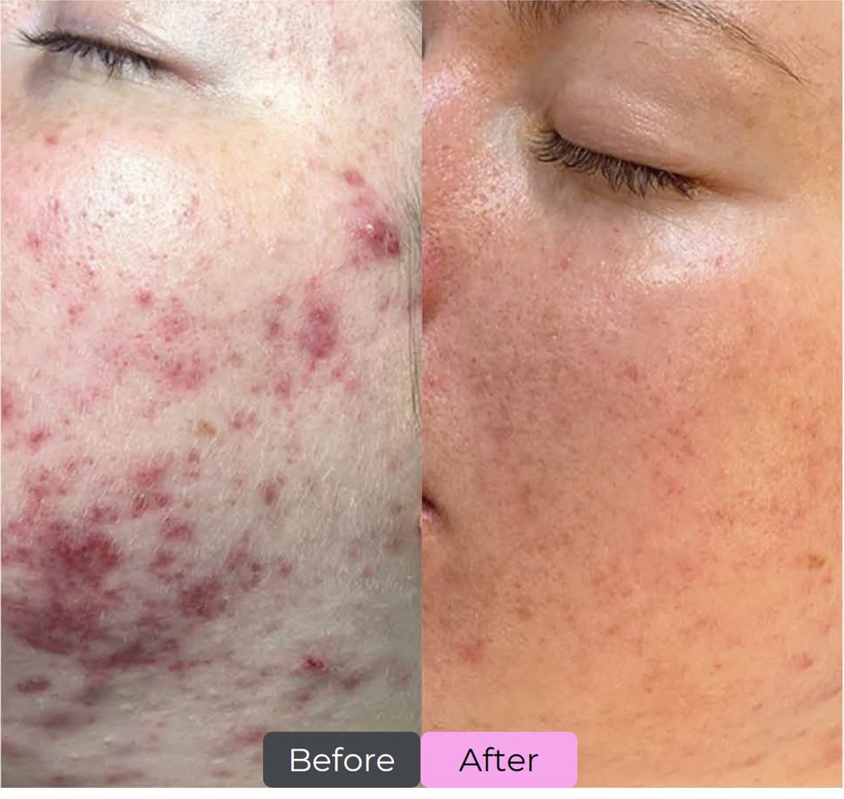 Before and after Dermalux LED phototherapy — active acne and blemish-prone skin
