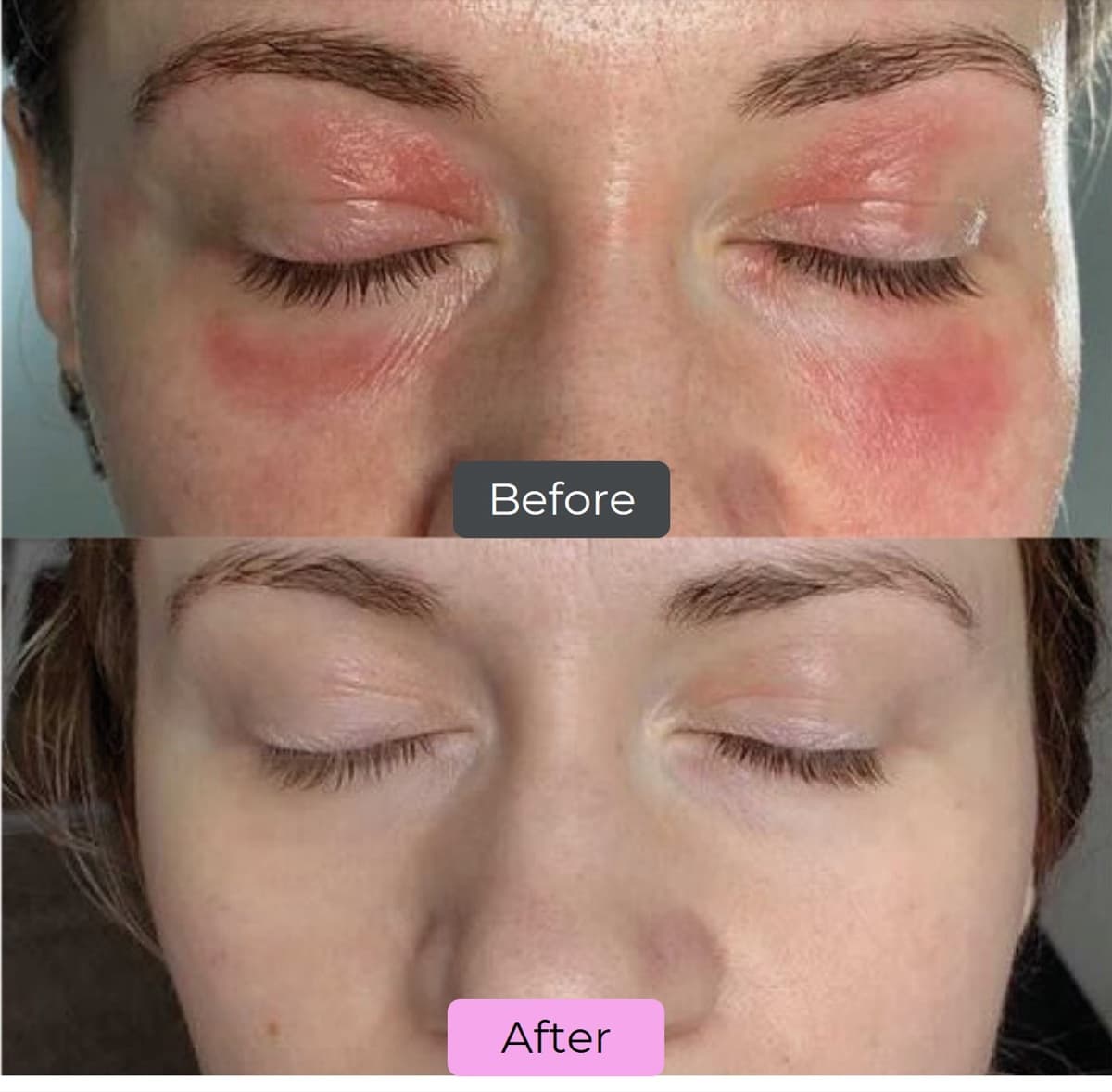 Before and after Dermalux LED phototherapy — redness and irritation around the eyes
