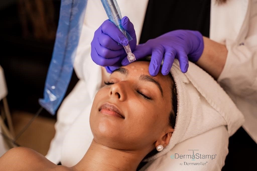 Microneedling