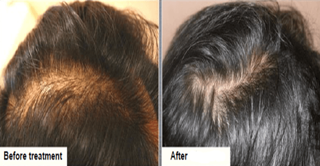 Scalp microneedling — male patient